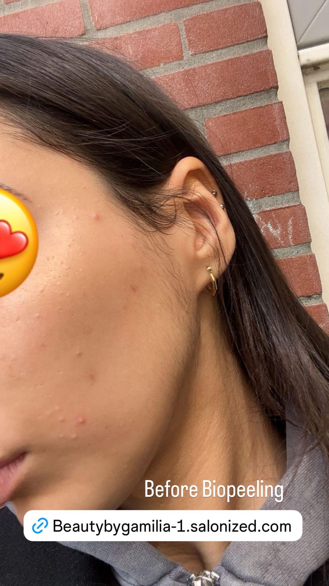 Before Biopeeling behandeling