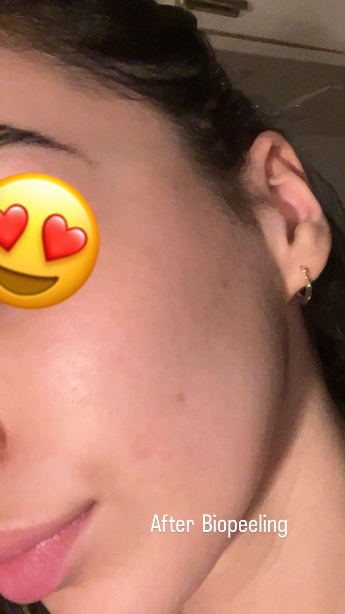 After Biopeeling behandeling